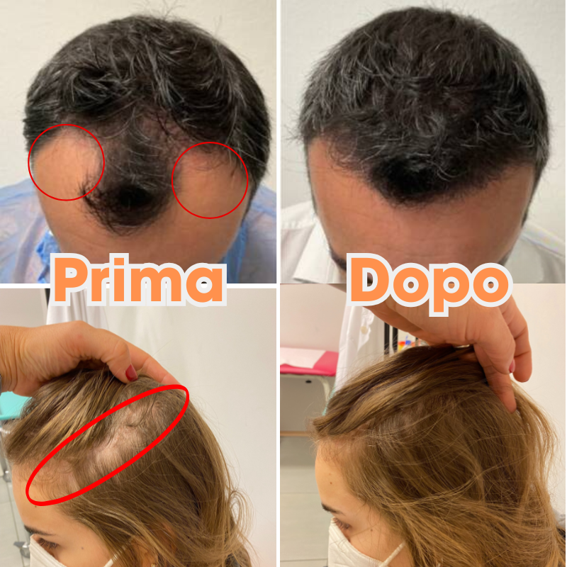 TricoRosmarinus: Lozione Anti-caduta dei capelli | Rinfoltisce e Rinforza